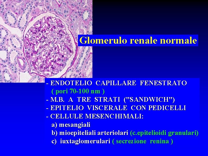 Glomerulo renale normale - ENDOTELIO CAPILLARE FENESTRATO ( pori 70 -100 nm ) -