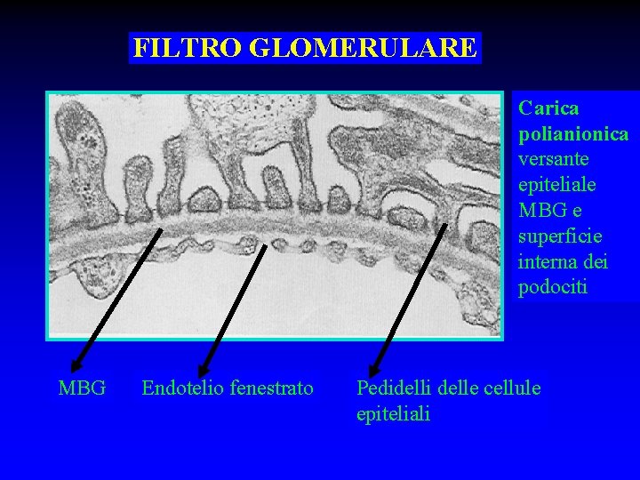 FILTRO GLOMERULARE Carica polianionica versante epiteliale MBG e superficie interna dei podociti MBG Endotelio
