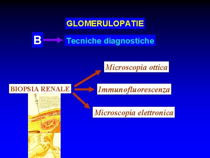 GLOMERULOPATIE B Tecniche diagnostiche Microscopia ottica BIOPSIA RENALE Immunofluorescenza Microscopia elettronica 