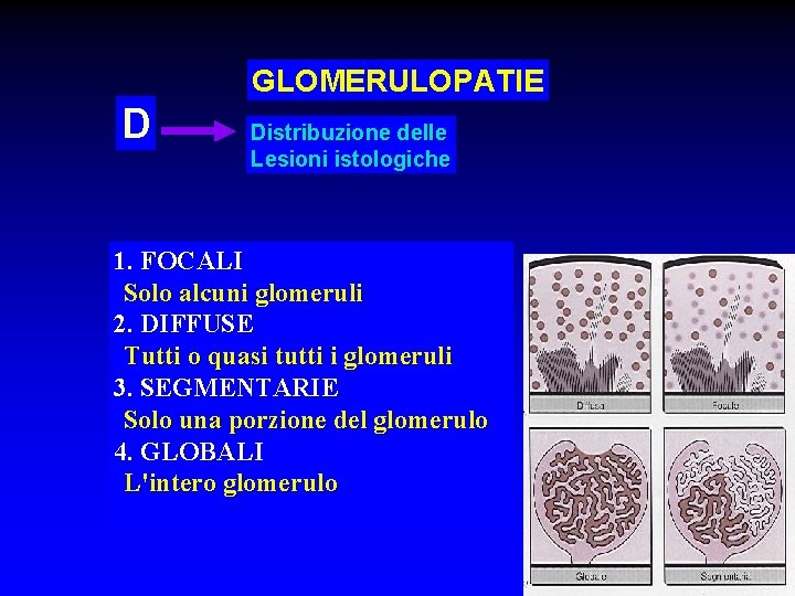 GLOMERULOPATIE D Distribuzione delle Lesioni istologiche 1. FOCALI Solo alcuni glomeruli 2. DIFFUSE Tutti
