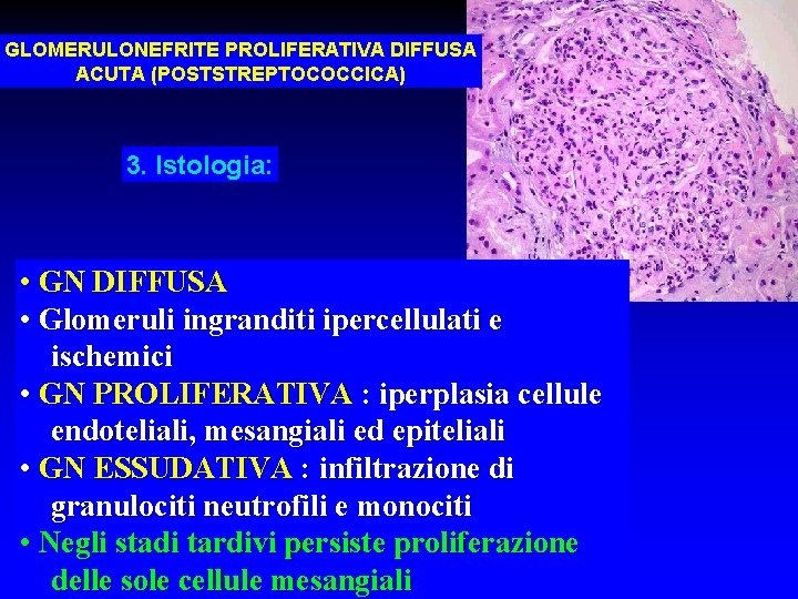 GLOMERULONEFRITE PROLIFERATIVA DIFFUSA ACUTA (POSTSTREPTOCOCCICA) 3. Istologia: • GN DIFFUSA • Glomeruli ingranditi ipercellulati