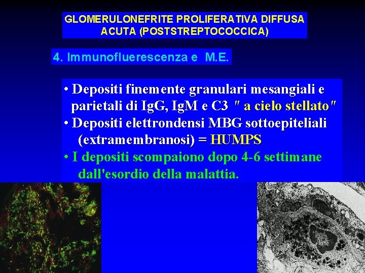 GLOMERULONEFRITE PROLIFERATIVA DIFFUSA ACUTA (POSTSTREPTOCOCCICA) 4. Immunofluerescenza e M. E. • Depositi finemente granulari