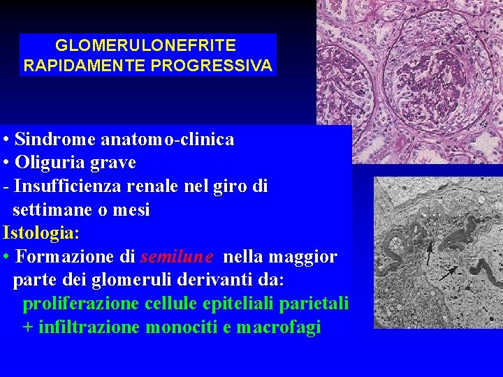 GLOMERULONEFRITE RAPIDAMENTE PROGRESSIVA • Sindrome anatomo-clinica • Oliguria grave - Insufficienza renale nel giro