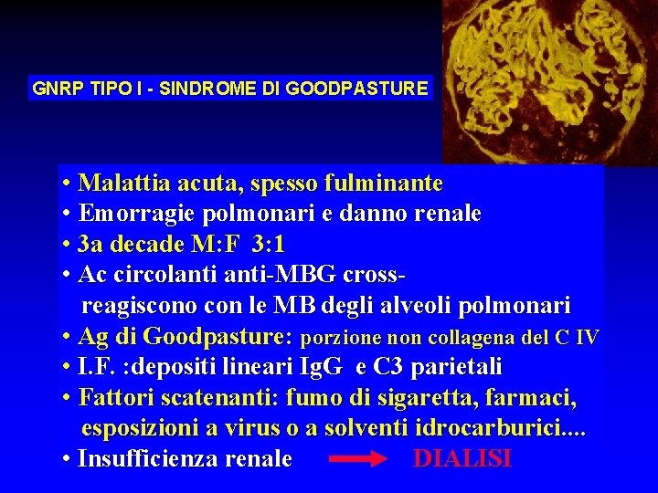 GNRP TIPO I - SINDROME DI GOODPASTURE • Malattia acuta, spesso fulminante • Emorragie