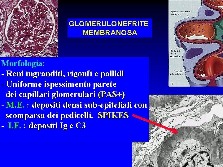 GLOMERULONEFRITE MEMBRANOSA Morfologia: - Reni ingranditi, rigonfi e pallidi - Uniforme ispessimento parete dei