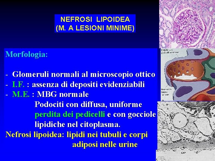 NEFROSI LIPOIDEA (M. A LESIONI MINIME) Morfologia: - Glomeruli normali al microscopio ottico I.