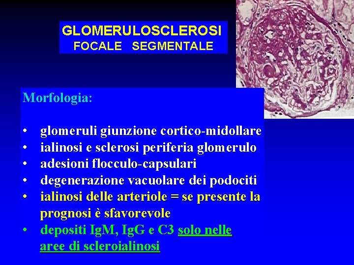 GLOMERULOSCLEROSI FOCALE SEGMENTALE Morfologia: • • • glomeruli giunzione cortico-midollare ialinosi e sclerosi periferia
