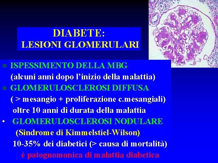 DIABETE: LESIONI GLOMERULARI ISPESSIMENTO DELLA MBG (alcuni anni dopo l’inizio della malattia) n GLOMERULOSCLEROSI