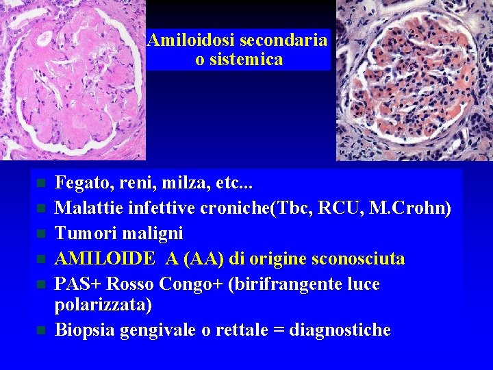 Amiloidosi secondaria o sistemica n n n Fegato, reni, milza, etc. . . Malattie