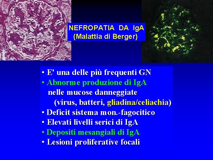 NEFROPATIA DA Ig. A (Malattia di Berger) • E' una delle più frequenti GN
