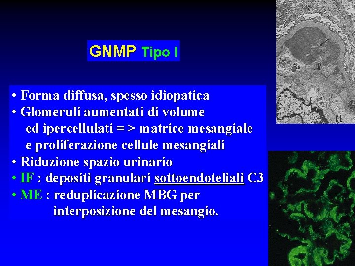 GNMP Tipo I • Forma diffusa, spesso idiopatica • Glomeruli aumentati di volume ed