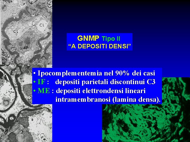 GNMP Tipo II “A DEPOSITI DENSI” • Ipocomplementemia nel 90% dei casi • IF