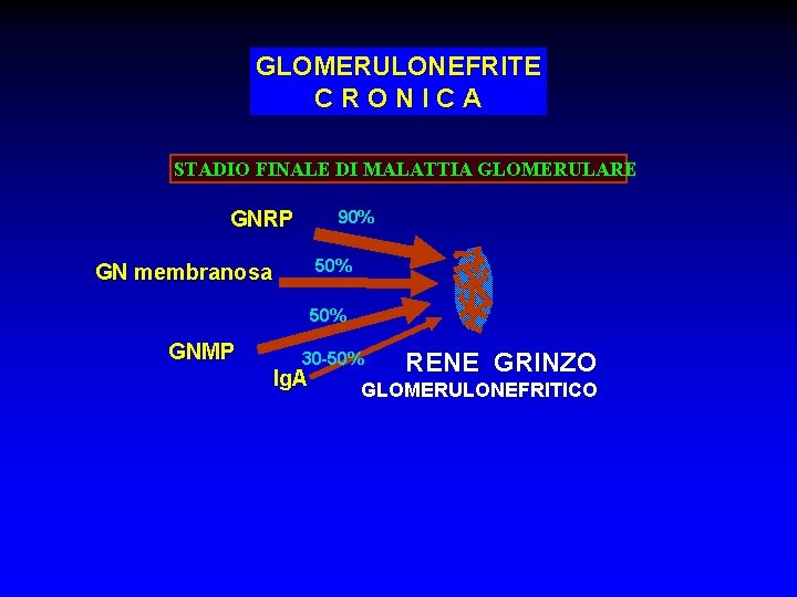 GLOMERULONEFRITE CRONICA STADIO FINALE DI MALATTIA GLOMERULARE GNRP 90% 50% GN membranosa 50% GNMP