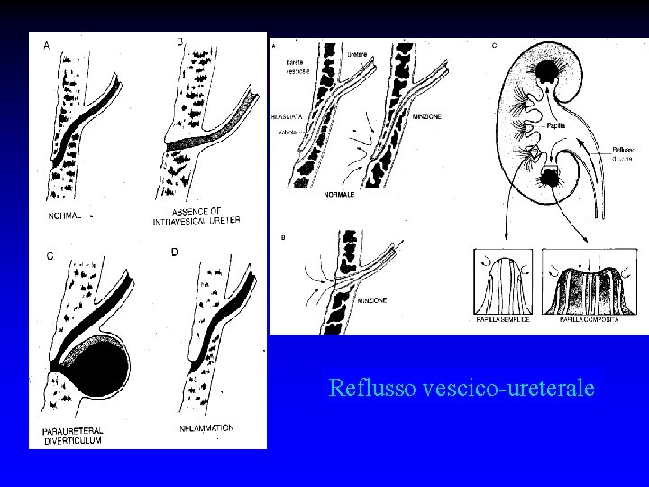 Reflusso vescico-ureterale 