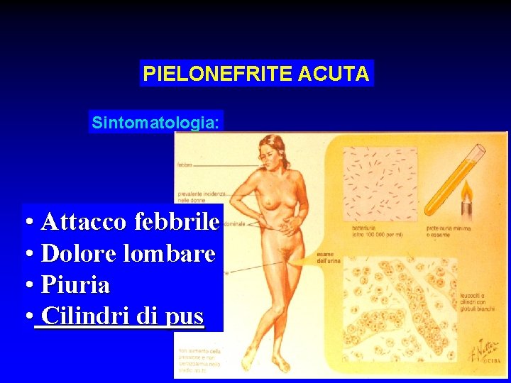 PIELONEFRITE ACUTA Sintomatologia: • Attacco febbrile • Dolore lombare • Piuria • Cilindri di