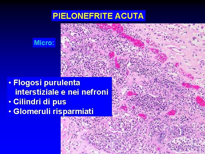 PIELONEFRITE ACUTA Micro: • Flogosi purulenta interstiziale e nei nefroni • Cilindri di pus