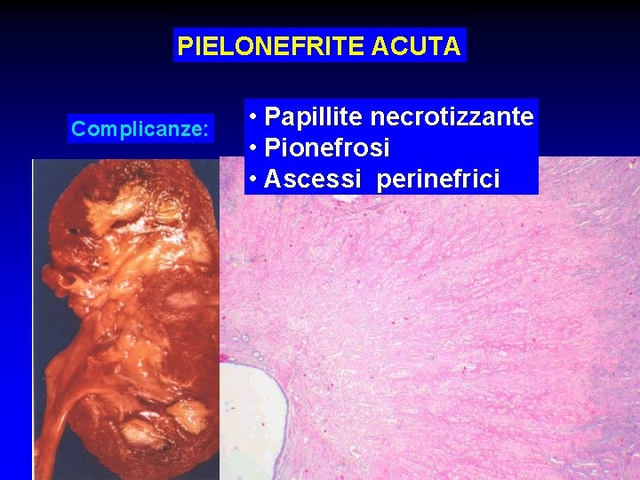 PIELONEFRITE ACUTA Complicanze: • Papillite necrotizzante • Pionefrosi • Ascessi perinefrici 