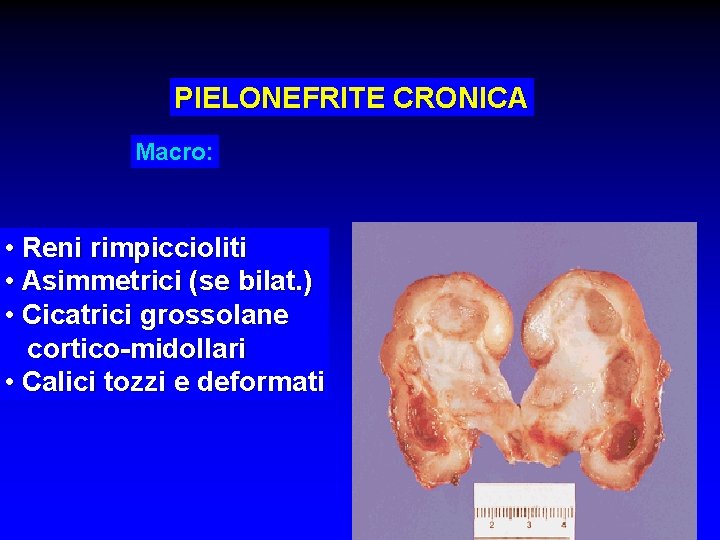 PIELONEFRITE CRONICA Macro: • Reni rimpiccioliti • Asimmetrici (se bilat. ) • Cicatrici grossolane