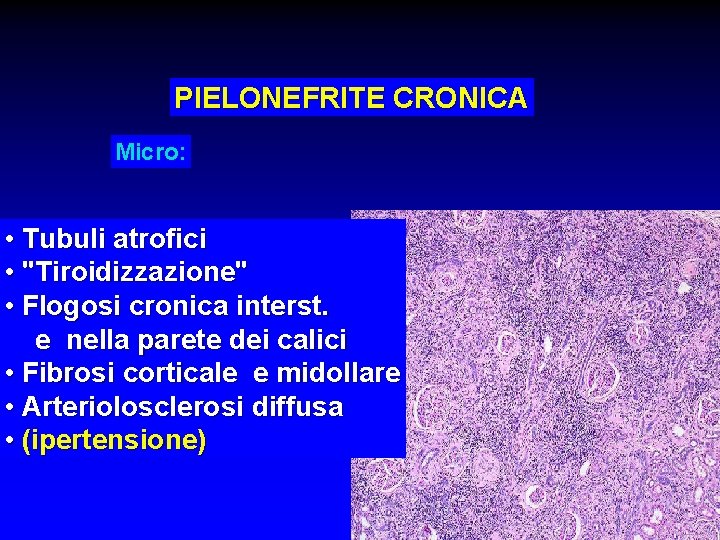 PIELONEFRITE CRONICA Micro: • Tubuli atrofici • "Tiroidizzazione" • Flogosi cronica interst. e nella