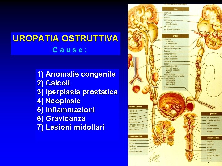 UROPATIA OSTRUTTIVA Cause: 1) Anomalie congenite 2) Calcoli 3) Iperplasia prostatica 4) Neoplasie 5)