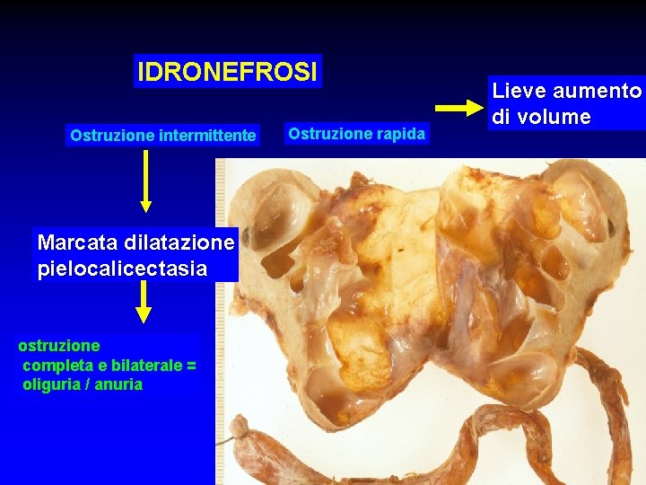IDRONEFROSI Ostruzione intermittente Marcata dilatazione pielocalicectasia ostruzione completa e bilaterale = oliguria / anuria