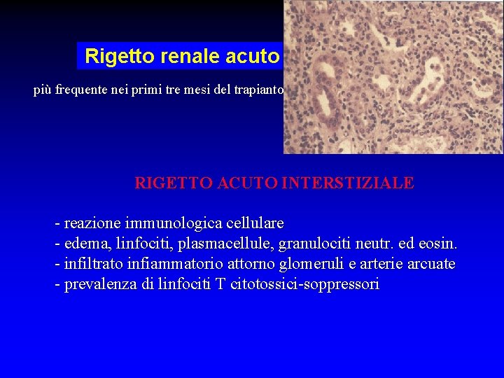 Rigetto renale acuto più frequente nei primi tre mesi del trapianto RIGETTO ACUTO INTERSTIZIALE