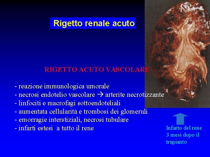 Rigetto renale acuto RIGETTO ACUTO VASCOLARE - reazione immunologica umorale - necrosi endotelio vascolare