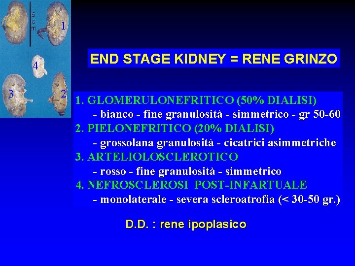 1 END STAGE KIDNEY = RENE GRINZO 4 3 2 1. GLOMERULONEFRITICO (50% DIALISI)