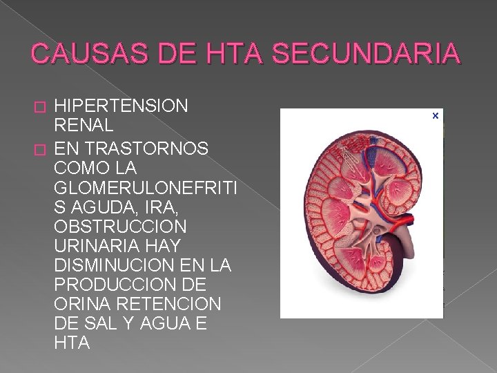 CAUSAS DE HTA SECUNDARIA HIPERTENSION RENAL � EN TRASTORNOS COMO LA GLOMERULONEFRITI S AGUDA,