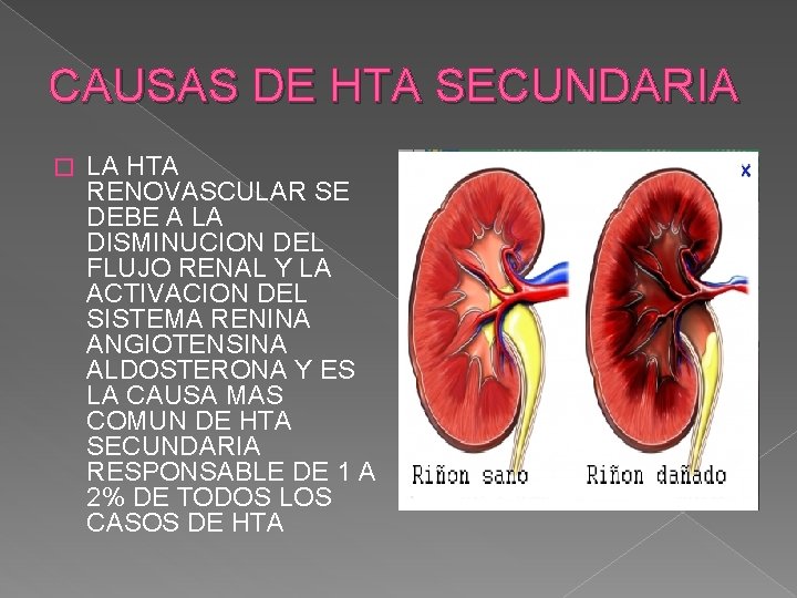 CAUSAS DE HTA SECUNDARIA � LA HTA RENOVASCULAR SE DEBE A LA DISMINUCION DEL