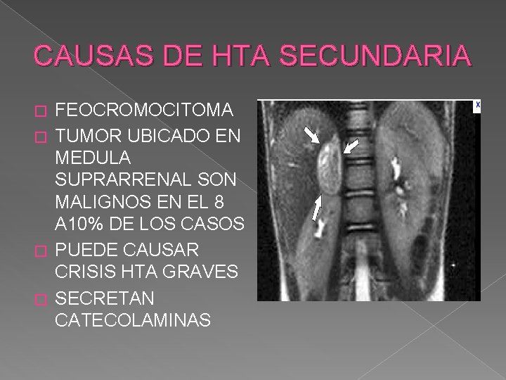 CAUSAS DE HTA SECUNDARIA FEOCROMOCITOMA � TUMOR UBICADO EN MEDULA SUPRARRENAL SON MALIGNOS EN