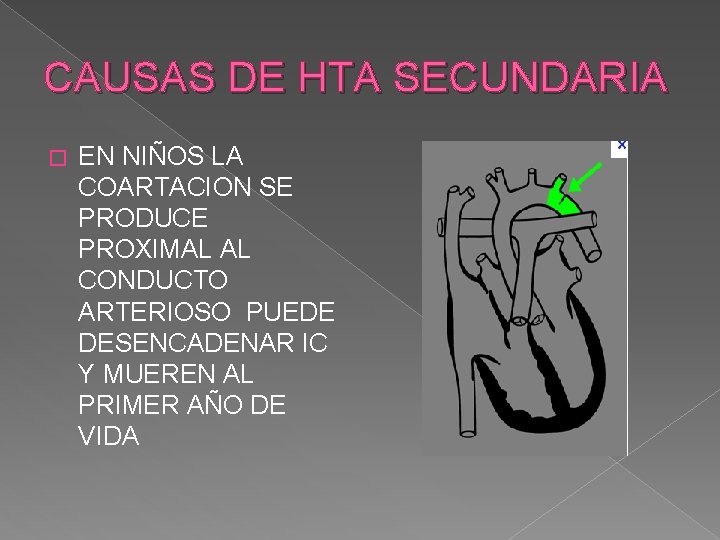 CAUSAS DE HTA SECUNDARIA � EN NIÑOS LA COARTACION SE PRODUCE PROXIMAL AL CONDUCTO