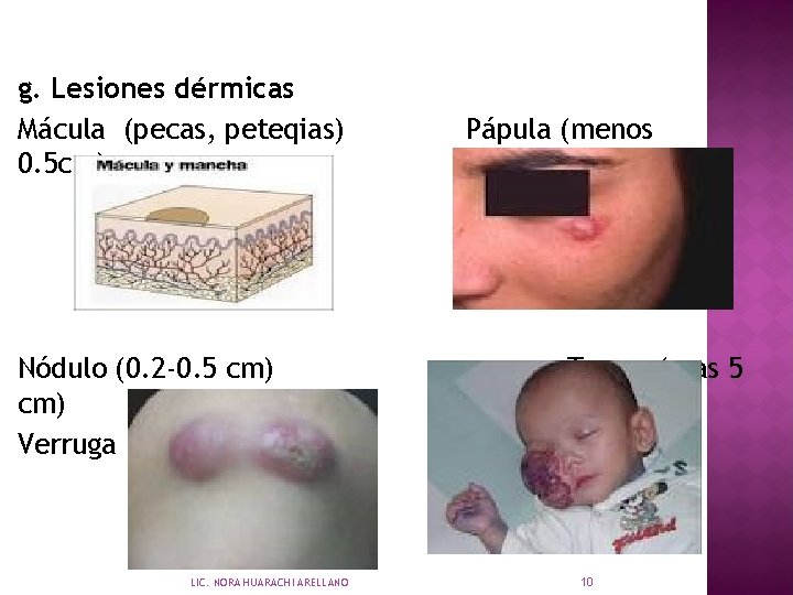 g. Lesiones dérmicas Mácula (pecas, peteqias) 0. 5 cm) Nódulo (0. 2 -0. 5