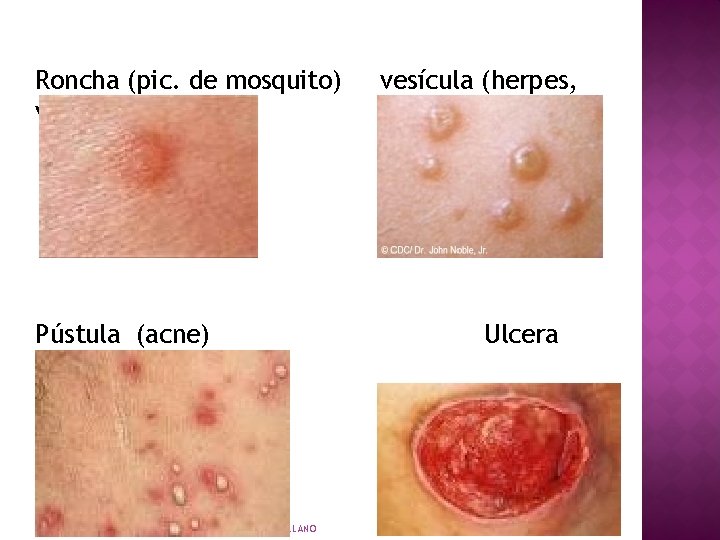 Roncha (pic. de mosquito) varicela) Pústula (acne) LIC. NORA HUARACHI ARELLANO vesícula (herpes, Ulcera