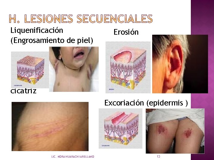 Liquenificación (Engrosamiento de piel) Erosión cicatriz Excoriación (epidermis ) LIC. NORA HUARACHI ARELLANO 13