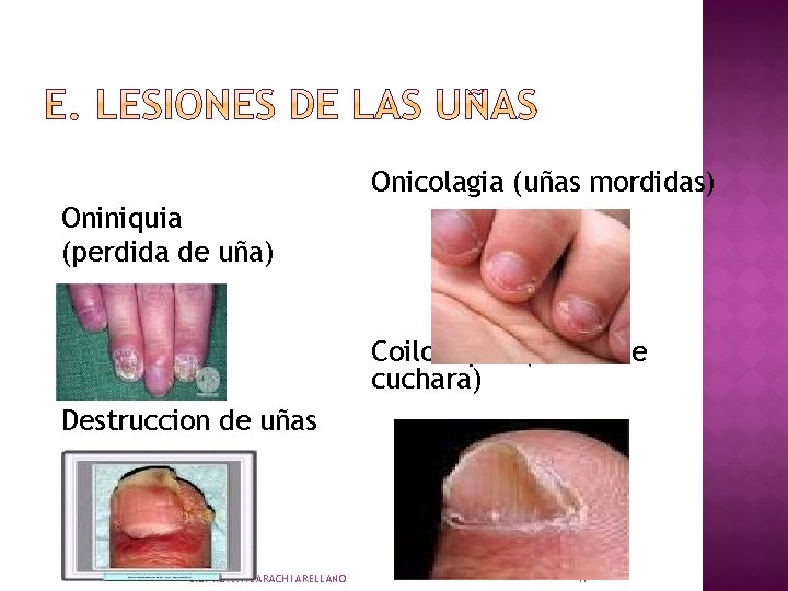 Onicolagia (uñas mordidas) Oniniquia (perdida de uña) Onicolisis Destruccion de uñas LIC. NORA HUARACHI