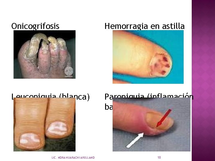 Onicogrifosis Hemorragia en astilla Leuconiquia (blanca) Paroniquia (inflamación base) LIC. NORA HUARACHI ARELLANO 18