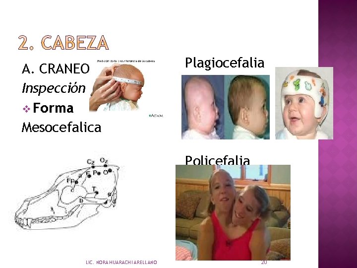 A. CRANEO Inspección v Forma Mesocefalica Plagiocefalia Policefalia LIC. NORA HUARACHI ARELLANO 20 