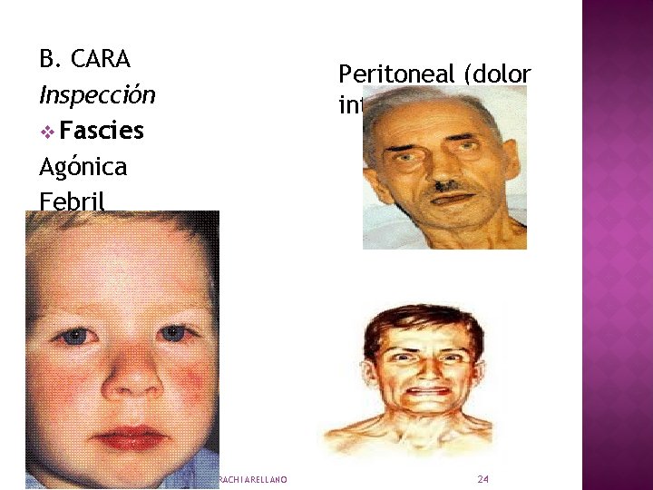 B. CARA Inspección v Fascies Agónica Febril Peritoneal (dolor intenso) Sardónica LIC. NORA HUARACHI