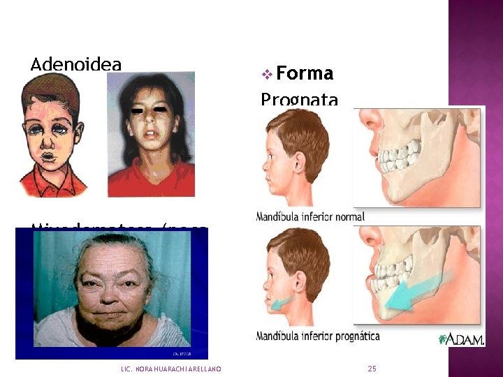 Adenoidea v Forma Prognata Mixedematosa (poca expr) LIC. NORA HUARACHI ARELLANO 25 