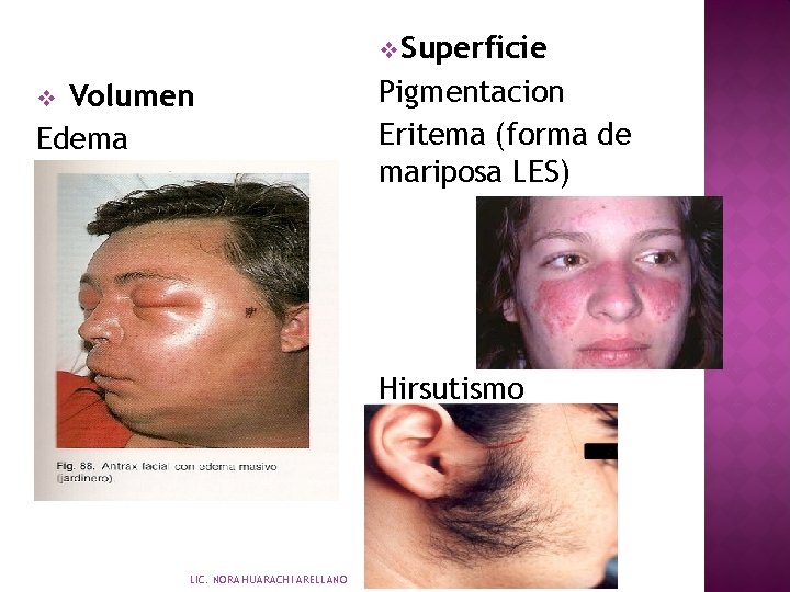 v Superficie Volumen Edema v Pigmentacion Eritema (forma de mariposa LES) Hirsutismo LIC. NORA