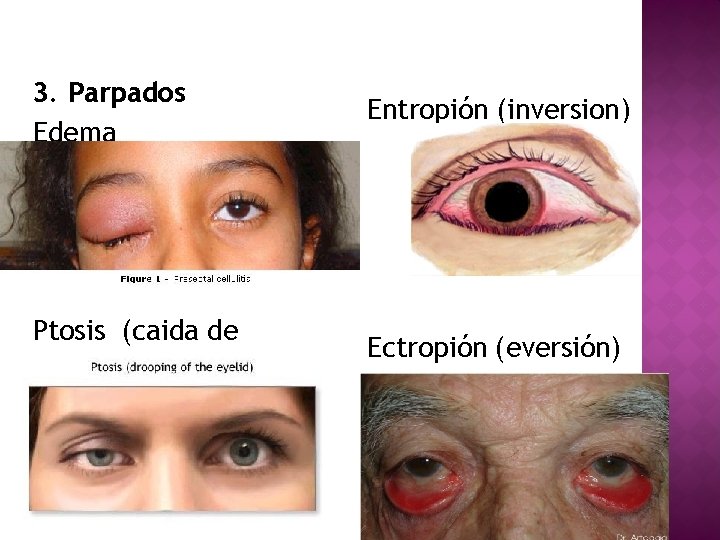 3. Parpados Edema Entropión (inversion) Ptosis (caida de parpados) Ectropión (eversión) LIC. NORA HUARACHI