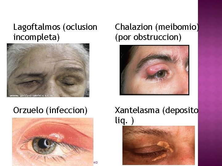 Lagoftalmos (oclusion incompleta) Chalazion (meibomio) (por obstruccion) Orzuelo (infeccion) Xantelasma (deposito liq. ) LIC.