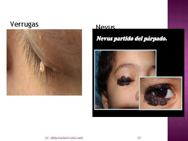 Verrugas Nevus LIC. NORA HUARACHI ARELLANO 33 