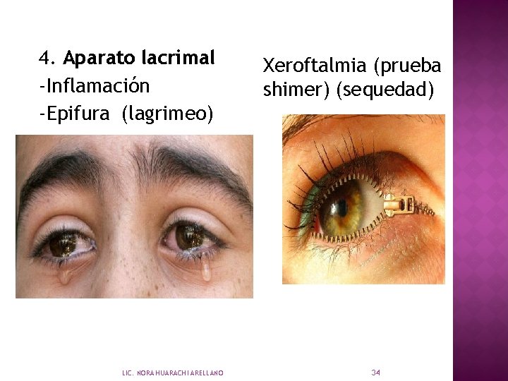 4. Aparato lacrimal -Inflamación -Epifura (lagrimeo) LIC. NORA HUARACHI ARELLANO Xeroftalmia (prueba shimer) (sequedad)