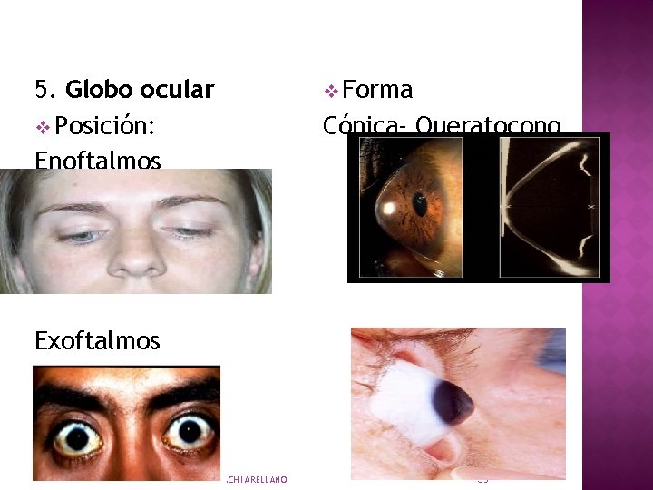 5. Globo ocular v Posición: Enoftalmos v Forma Cónica- Queratocono Exoftalmos LIC. NORA HUARACHI