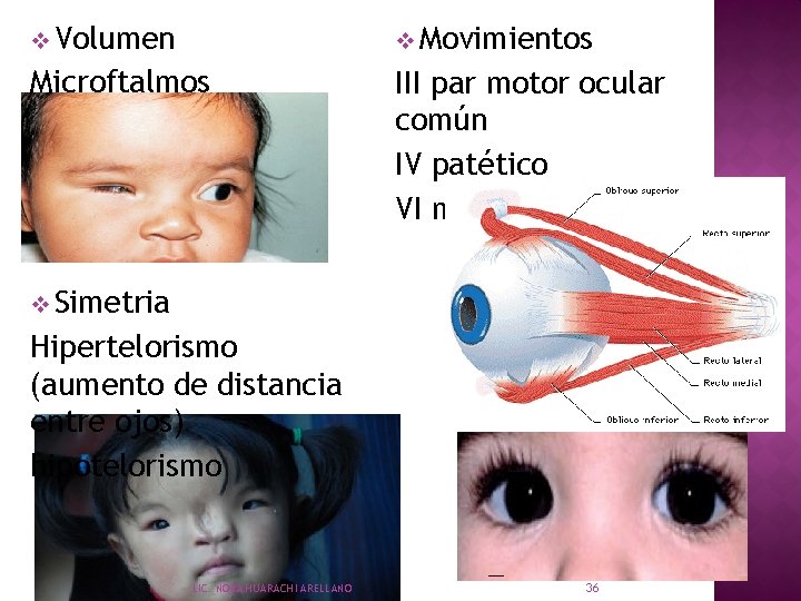 v Volumen v Movimientos Microftalmos III par motor ocular común IV patético VI motor