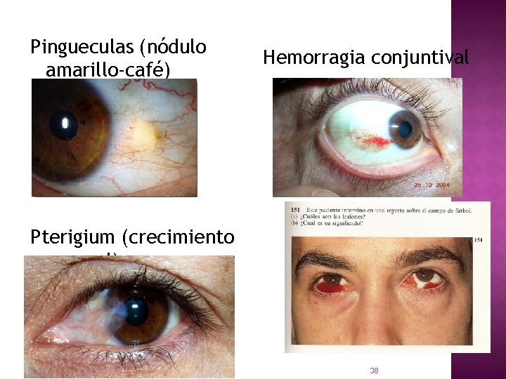 Pingueculas (nódulo amarillo-café) Hemorragia conjuntival Pterigium (crecimiento anornal) LIC. NORA HUARACHI ARELLANO 38 