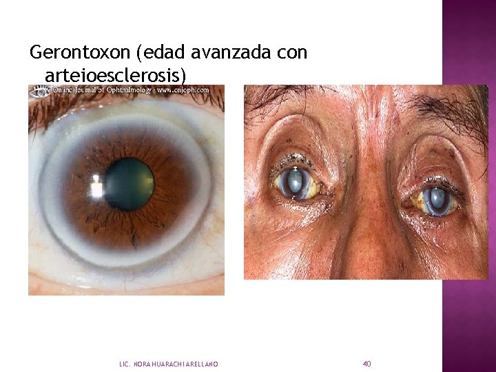 Gerontoxon (edad avanzada con arteioesclerosis) LIC. NORA HUARACHI ARELLANO 40 