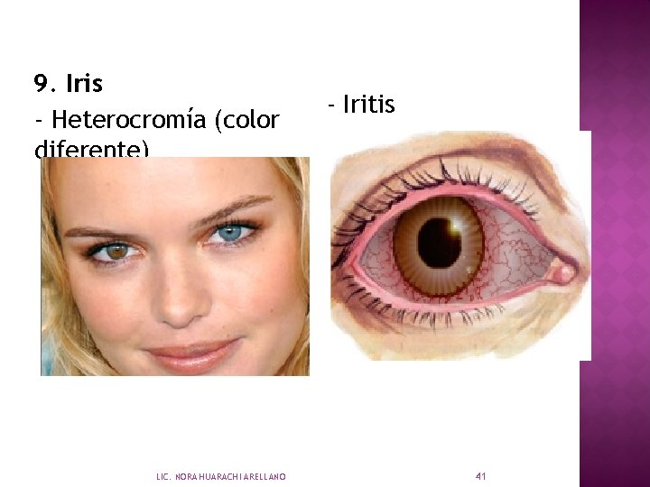 9. Iris - Heterocromía (color diferente) LIC. NORA HUARACHI ARELLANO - Iritis 41 